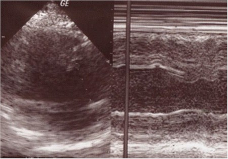infarto_miocardio_ecocardiograma2 infarto_miocardio_ecocardiograma2