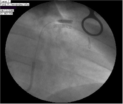 infarto_miocardio_venografia_coronaria