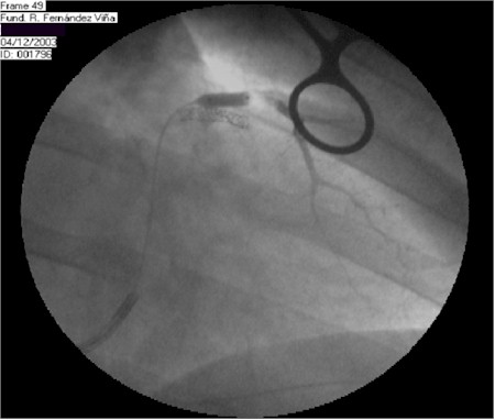 infarto_miocardio_venografia_coronaria2