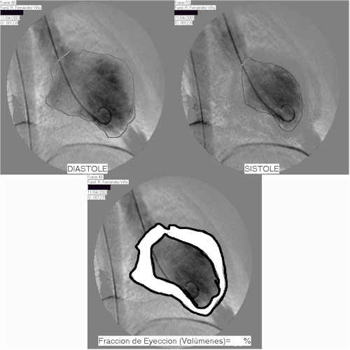 infarto_miocardio_ventriculo_post_implante