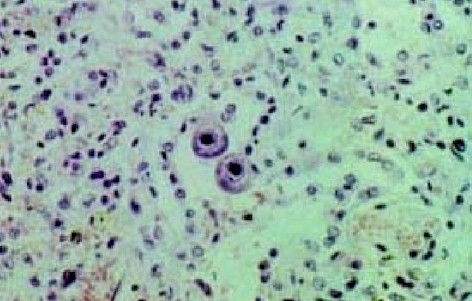 citomegalia citomegalia