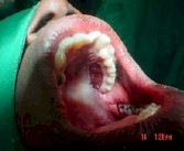 injerto_gingival_libre11 injerto_gingival_libre11