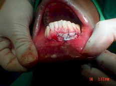 injerto_gingival_libre12 injerto_gingival_libre12
