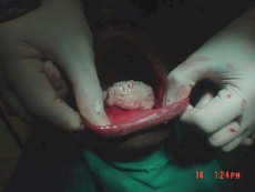 injerto_gingival_libre13 injerto_gingival_libre13