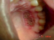 injerto_gingival_libre14