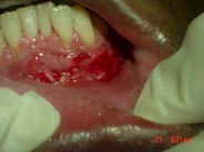 injerto_gingival_libre15 injerto_gingival_libre15