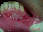 injerto_gingival_libre17 injerto_gingival_libre17