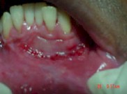 injerto_gingival_libre17