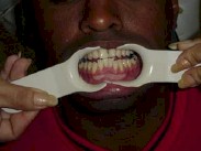 injerto_gingival_libre18 injerto_gingival_libre18