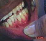 injerto_gingival_libre2 injerto_gingival_libre2