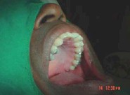injerto_gingival_libre6 injerto_gingival_libre6