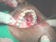 injerto_gingival_libre8 injerto_gingival_libre8