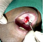 injerto_gingival_libre9 injerto_gingival_libre9