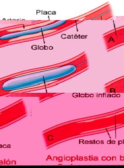 insuficiencia_coronaria