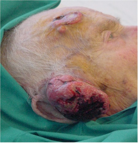 lesion_metastasica lesion_metastasica