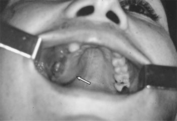 linfoma_no_hodgkin linfoma_no_hodgkin