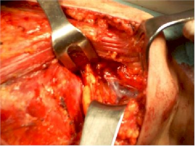 mastectomia_diseccion_axila mastectomia_diseccion_axila