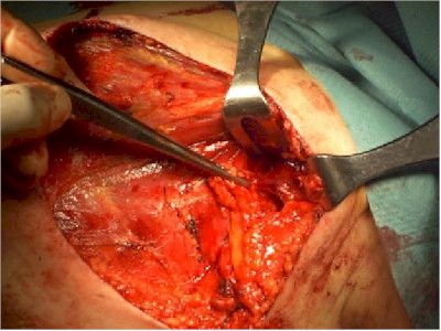 mastectomia_diseccion_pectorales mastectomia_diseccion_pectorales