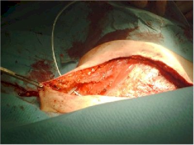 mastectomia_redones mastectomia_redones