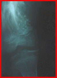enfermedad_Ollier2