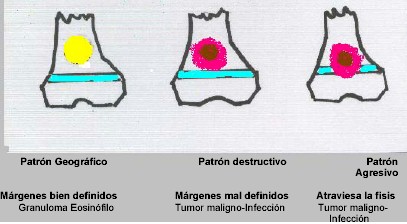 lesion_hueso lesion_hueso