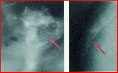 osteoblastoma