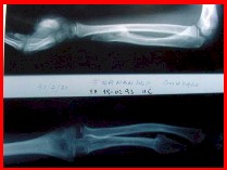 osteocondroma2