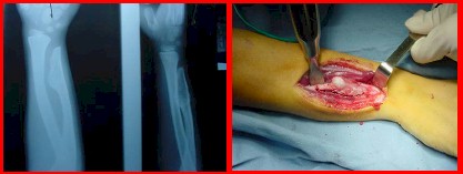 osteocondroma_tratamiento_quirurgico