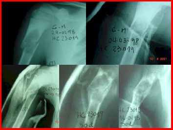 osteoma_fractura_patologica