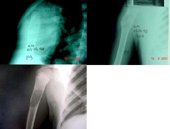 osteoma_fractura_patologica2