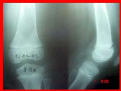 osteosarcoma