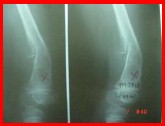 osteosarcoma2