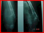 osteosarcoma3