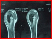 osteosarcoma6