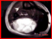 rabdomiosarcoma2