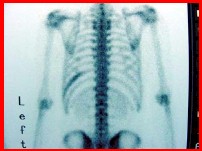 tumor_Askin