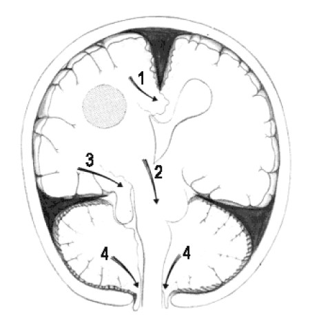 meningoencefalitis_bacteriana_hernias_cerebrales