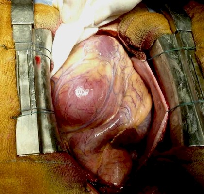 mixoma_cardiaco mixoma_cardiaco