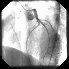 mixoma_cardiaco_coronariografia mixoma_cardiaco_coronariografia