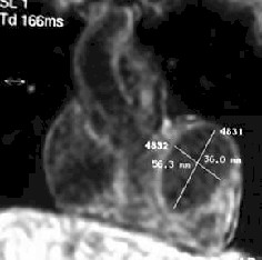mixoma_cardiaco_resonancia mixoma_cardiaco_resonancia