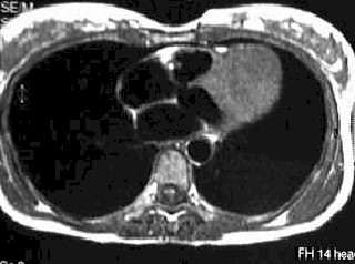 mixoma_cardiaco_resonancia2 mixoma_cardiaco_resonancia2