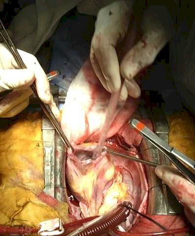 mixoma_cardiaco_ventriculotomia mixoma_cardiaco_ventriculotomia