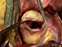 mixoma_cardiaco_ventriculotomia2 mixoma_cardiaco_ventriculotomia2