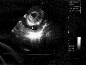 http://www.portalesmedicos.com/images/publicaciones/nefritis_lupica/nefritis_lupica10.jpg http://www.portalesmedicos.com/images/publicaciones/nefritis_lupica/nefritis_lupica10.jpg