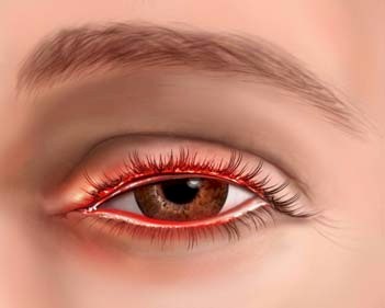 oftalmologia_blefaritis