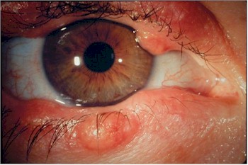 oftalmologia_blefaritis2