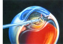 oftalmologia_cirugia_quirurgica3