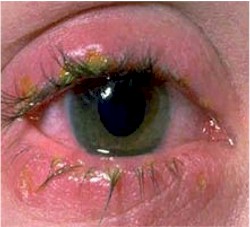 oftalmologia_conjuntivitis