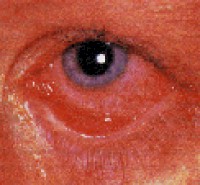 oftalmologia_conjuntivitis_bacteriana