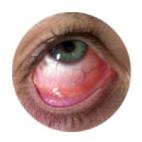 oftalmologia_conjuntivitis_bacteriana2